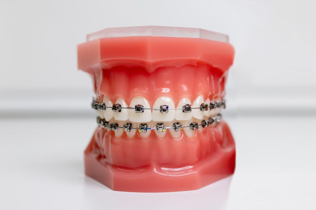 台中自鎖式矯正價格-牙齒矯正專科醫師推薦-台中西屯河馬牙醫診所