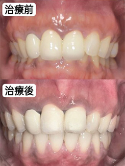 case-o-non-extraction-n-1-1