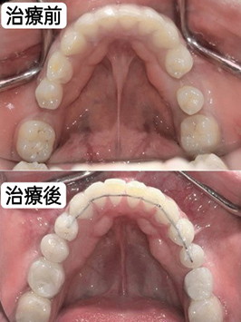 case-o-non-extraction-n-2-1
