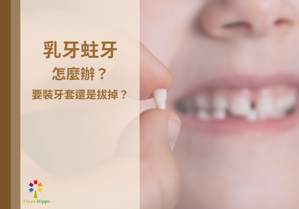 乳牙蛀牙怎麼辦？要裝牙套還是拔掉？