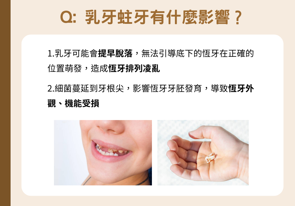 乳牙蛀牙有什麼影響？